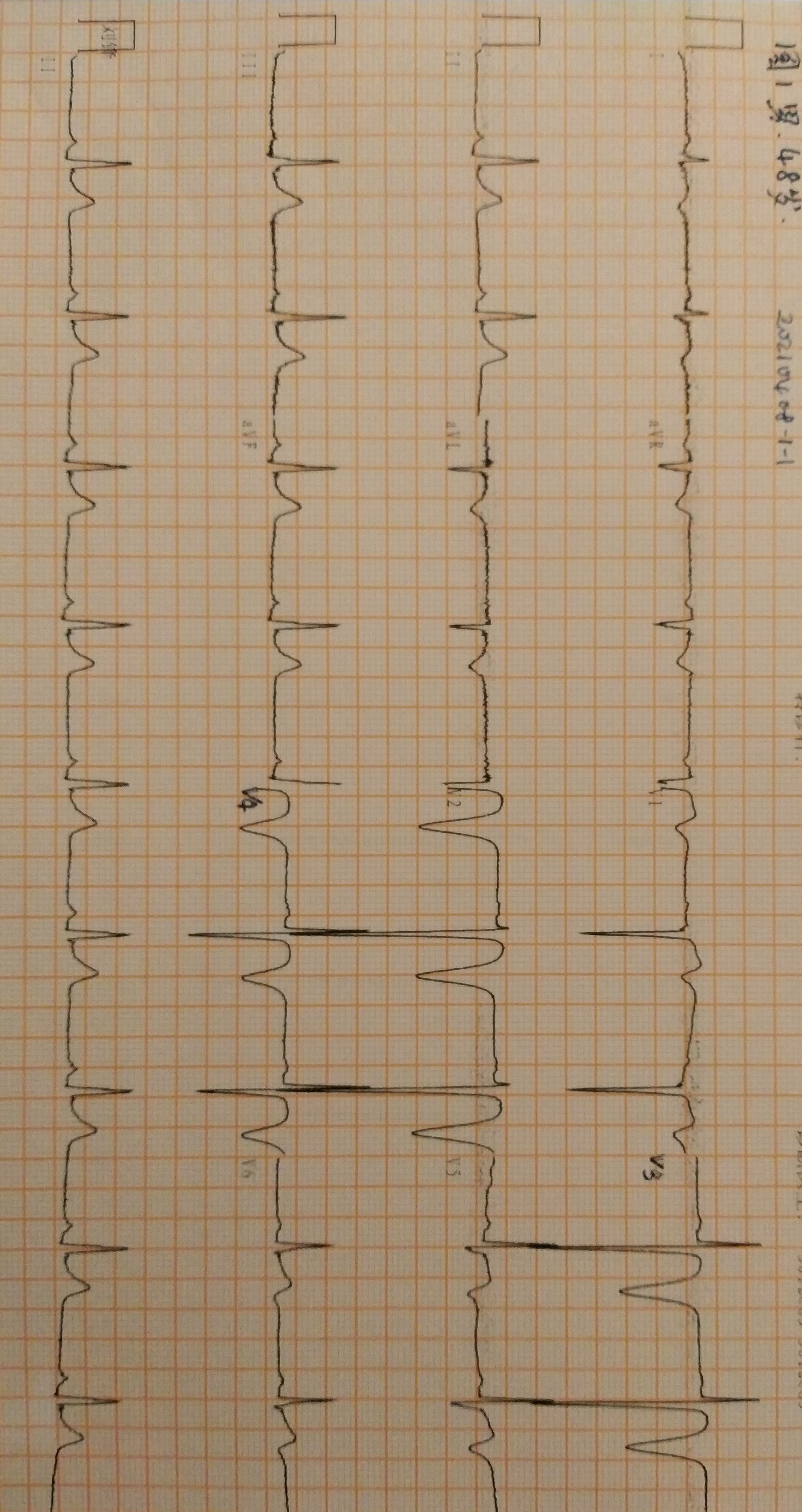 心电图常见干扰波形图片